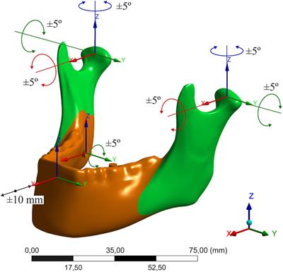 A Biomechanical Analysis of Muscle Force Changes After Bilateral Sagittal Split Osteotomy